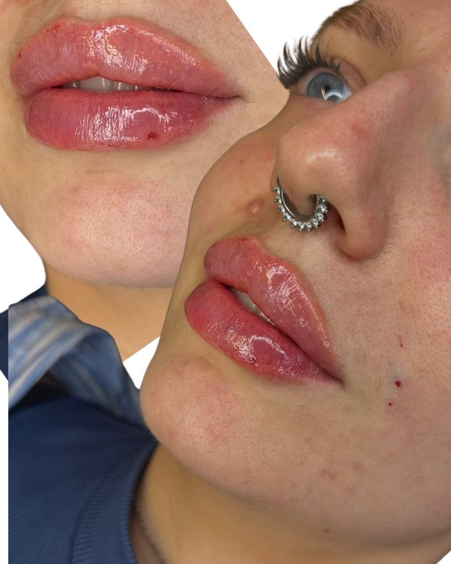 Lip filler before and after